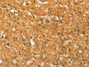 The image on the left is immunohistochemistry of paraffin-embedded Human liver cancer tissue using CSB-PA275949(TM7SF2 Antibody) at dilution 1/30, on the right is treated with synthetic peptide. (Original magnification: ×200)