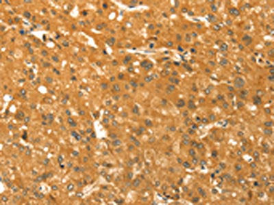 The image on the left is immunohistochemistry of paraffin-embedded Human liver cancer tissue using CSB-PA275949(TM7SF2 Antibody) at dilution 1/30, on the right is treated with synthetic peptide. (Original magnification: ×200)