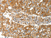 The image on the left is immunohistochemistry of paraffin-embedded Human breast cancer tissue using CSB-PA275964(TEP1 Antibody) at dilution 1/40, on the right is treated with synthetic peptide. (Original magnification: ×200)