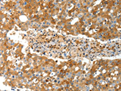 The image on the left is immunohistochemistry of paraffin-embedded Human breast cancer tissue using CSB-PA275964(TEP1 Antibody) at dilution 1/40, on the right is treated with synthetic peptide. (Original magnification: ×200)