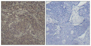 Immunohistochemical analysis of paraffin-embedded human breast carcinoma tissue using CREB (Phospho-Ser142) Antibody.