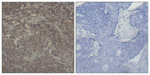 Immunohistochemical analysis of paraffin-embedded human breast carcinoma tissue using CREB (Phospho-Ser142) Antibody.