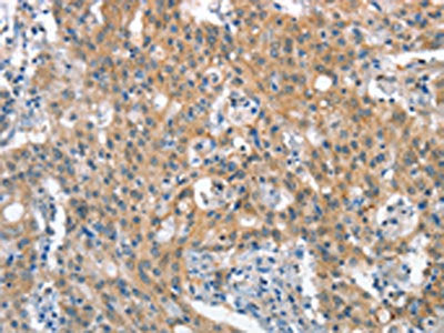 The image on the left is immunohistochemistry of paraffin-embedded Human gastic cancer tissue using CSB-PA276122(STAT2 Antibody) at dilution 1/40, on the right is treated with synthetic peptide. (Original magnification: ×200)