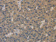 The image on the left is immunohistochemistry of paraffin-embedded Human liver cancer tissue using CSB-PA276232(EMC8 Antibody) at dilution 1/30, on the right is treated with fusion protein. (Original magnification: ×200)