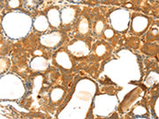The image on the left is immunohistochemistry of paraffin-embedded Human thyroid cancer tissue using CSB-PA276625(TM7SF2 Antibody) at dilution 1/25, on the right is treated with synthetic peptide. (Original magnification: ×200)