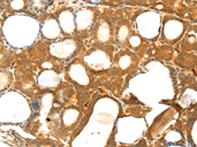 The image on the left is immunohistochemistry of paraffin-embedded Human thyroid cancer tissue using CSB-PA276625(TM7SF2 Antibody) at dilution 1/25, on the right is treated with synthetic peptide. (Original magnification: ×200)