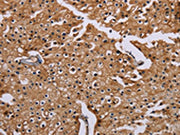 The image on the left is immunohistochemistry of paraffin-embedded Human prostate cancer tissue using CSB-PA276669(CSNK1A1 Antibody) at dilution 1/20, on the right is treated with synthetic peptide. (Original magnification: ×200)