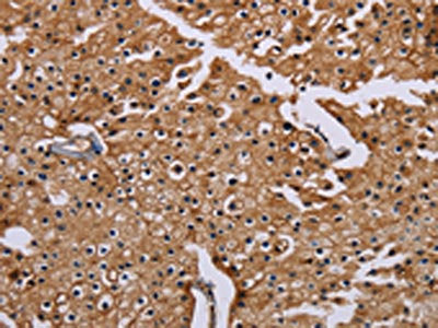The image on the left is immunohistochemistry of paraffin-embedded Human prostate cancer tissue using CSB-PA276669(CSNK1A1 Antibody) at dilution 1/20, on the right is treated with synthetic peptide. (Original magnification: ×200)