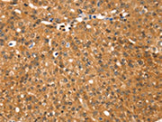 The image on the left is immunohistochemistry of paraffin-embedded Human breast cancer tissue using CSB-PA276672(RGS22 Antibody) at dilution 1/25, on the right is treated with fusion protein. (Original magnification: ×200)