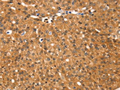 The image on the left is immunohistochemistry of paraffin-embedded Human breast cancer tissue using CSB-PA276672(RGS22 Antibody) at dilution 1/25, on the right is treated with fusion protein. (Original magnification: ×200)