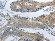 The image on the left is immunohistochemistry of paraffin-embedded Human colon cancer tissue using CSB-PA276678(SLC5A5 Antibody) at dilution 1/30, on the right is treated with synthetic peptide. (Original magnification: ×200)