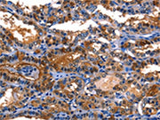 The image on the left is immunohistochemistry of paraffin-embedded Human thyroid cancer tissue using CSB-PA276679(LGALS8 Antibody) at dilution 1/10, on the right is treated with fusion protein. (Original magnification: ×200)