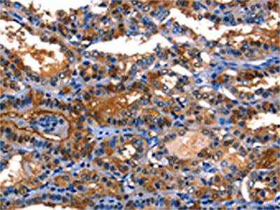 The image on the left is immunohistochemistry of paraffin-embedded Human thyroid cancer tissue using CSB-PA276679(LGALS8 Antibody) at dilution 1/10, on the right is treated with fusion protein. (Original magnification: ×200)