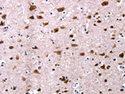 The image on the left is immunohistochemistry of paraffin-embedded Human brain tissue using CSB-PA276737(CSNK2A1 Antibody) at dilution 1/13, on the right is treated with fusion protein. (Original magnification: ×200)