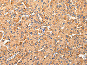 The image on the left is immunohistochemistry of paraffin-embedded Human liver cancer tissue using CSB-PA276755(AQP7 Antibody) at dilution 1/40, on the right is treated with synthetic peptide. (Original magnification: ×200)