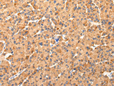 The image on the left is immunohistochemistry of paraffin-embedded Human liver cancer tissue using CSB-PA276755(AQP7 Antibody) at dilution 1/40, on the right is treated with synthetic peptide. (Original magnification: ×200)