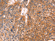 The image is immunohistochemistry of paraffin-embedded Human liver cancer tissue using CSB-PA276953(ANTXR1 Antibody) at dilution 1/25. (Original magnification: ×200)
