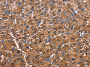 The image on the left is immunohistochemistry of paraffin-embedded Human liver cancer tissue using CSB-PA276963(ELP2 Antibody) at dilution 1/40, on the right is treated with fusion protein. (Original magnification: ×200)