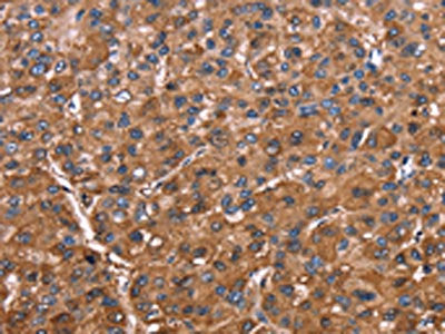 The image on the left is immunohistochemistry of paraffin-embedded Human liver cancer tissue using CSB-PA276963(ELP2 Antibody) at dilution 1/40, on the right is treated with fusion protein. (Original magnification: ×200)