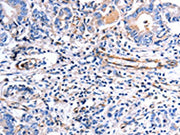 The image on the left is immunohistochemistry of paraffin-embedded Human stomach cancer tissue using CSB-PA277061(COX11 Antibody) at dilution 1/30, on the right is treated with fusion protein. (Original magnification: ×200)