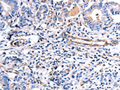 The image on the left is immunohistochemistry of paraffin-embedded Human stomach cancer tissue using CSB-PA277061(COX11 Antibody) at dilution 1/30, on the right is treated with fusion protein. (Original magnification: ×200)