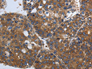 The image on the left is immunohistochemistry of paraffin-embedded Human liver cancer tissue using CSB-PA277236(SOCS1 Antibody) at dilution 1/90, on the right is treated with synthetic peptide. (Original magnification: ×200)