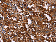 The image on the left is immunohistochemistry of paraffin-embedded Human thyroid cancer tissue using CSB-PA277276(GAGE12I Antibody) at dilution 1/20, on the right is treated with synthetic peptide. (Original magnification: ×200)