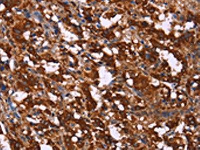 The image on the left is immunohistochemistry of paraffin-embedded Human thyroid cancer tissue using CSB-PA277276(GAGE12I Antibody) at dilution 1/20, on the right is treated with synthetic peptide. (Original magnification: ×200)