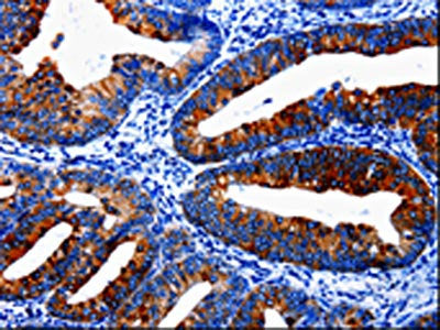 The image on the left is immunohistochemistry of paraffin-embedded Human cervical cancer tissue using CSB-PA277440(EPHX1 Antibody) at dilution 1/20, on the right is treated with fusion protein. (Original magnification: ×200)