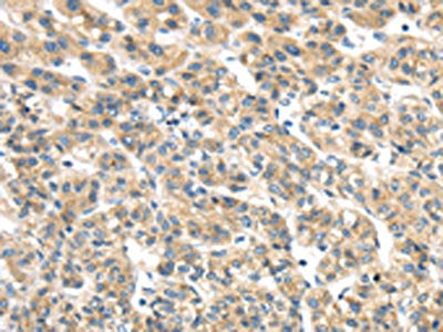 The image on the left is immunohistochemistry of paraffin-embedded Human liver cancer tissue using CSB-PA277474(TMED2 Antibody) at dilution 1/25, on the right is treated with fusion protein. (Original magnification: ×200)