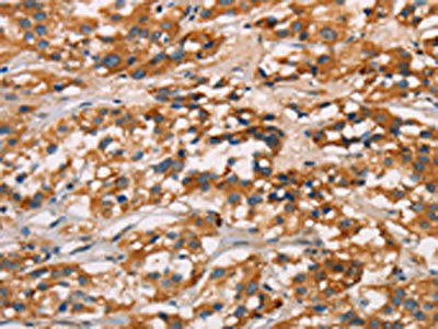 The image on the left is immunohistochemistry of paraffin-embedded Human thyroid cancer tissue using CSB-PA277650(CD80 Antibody) at dilution 1/50, on the right is treated with synthetic peptide. (Original magnification: ×200)