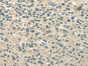 The image on the left is immunohistochemistry of paraffin-embedded Human liver cancer tissue using CSB-PA277716(UBAP2L Antibody) at dilution 1/25, on the right is treated with fusion protein. (Original magnification: ×200)