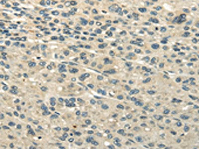 The image on the left is immunohistochemistry of paraffin-embedded Human liver cancer tissue using CSB-PA277716(UBAP2L Antibody) at dilution 1/25, on the right is treated with fusion protein. (Original magnification: ×200)