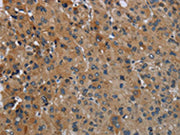 The image on the left is immunohistochemistry of paraffin-embedded Human liver cancer tissue using CSB-PA277783(FAAH Antibody) at dilution 1/50, on the right is treated with fusion protein. (Original magnification: ×200)