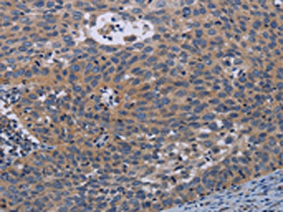 The image on the left is immunohistochemistry of paraffin-embedded Human cervical cancer tissue using CSB-PA277916(PAPPA Antibody) at dilution 1/50, on the right is treated with synthetic peptide. (Original magnification: ×200)