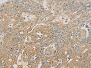 The image on the left is immunohistochemistry of paraffin-embedded Human breast cancer tissue using CSB-PA277938(SCAP Antibody) at dilution 1/20, on the right is treated with fusion protein. (Original magnification: ×200)