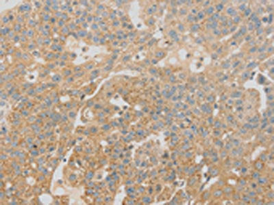 The image on the left is immunohistochemistry of paraffin-embedded Human breast cancer tissue using CSB-PA277938(SCAP Antibody) at dilution 1/20, on the right is treated with fusion protein. (Original magnification: ×200)