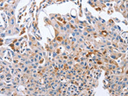 The image on the left is immunohistochemistry of paraffin-embedded Human lung cancer tissue using CSB-PA278214(NRG4 Antibody) at dilution 1/60, on the right is treated with fusion protein. (Original magnification: ×200)