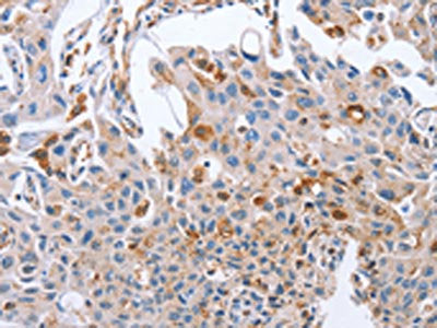 The image on the left is immunohistochemistry of paraffin-embedded Human lung cancer tissue using CSB-PA278214(NRG4 Antibody) at dilution 1/60, on the right is treated with fusion protein. (Original magnification: ×200)