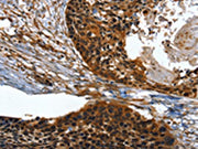 The image on the left is immunohistochemistry of paraffin-embedded Human esophagus cancer tissue using CSB-PA278516(TWF1 Antibody) at dilution 1/30, on the right is treated with fusion protein. (Original magnification: ×200)