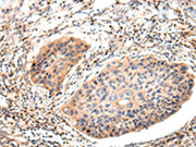 The image on the left is immunohistochemistry of paraffin-embedded Human esophagus cancer tissue using CSB-PA278626(Lambda Light chain Antibody) at dilution 1/20, on the right is treated with synthetic peptide. (Original magnification: ×200)