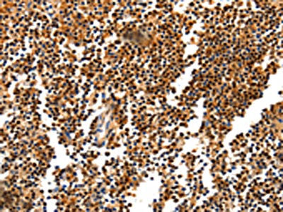 The image on the left is immunohistochemistry of paraffin-embedded Human tonsil tissue using CSB-PA278920(HDAC1 Antibody) at dilution 1/20, on the right is treated with synthetic peptide. (Original magnification: ×200)
