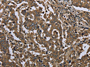 The image on the left is immunohistochemistry of paraffin-embedded Human liver cancer tissue using CSB-PA278921(GOLGA2 Antibody) at dilution 1/60, on the right is treated with fusion protein. (Original magnification: ×200)