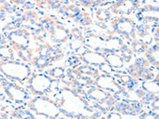The image on the left is immunohistochemistry of paraffin-embedded Human thyroid cancer tissue using CSB-PA279017(ACSM5 Antibody) at dilution 1/35, on the right is treated with fusion protein. (Original magnification: ×200)