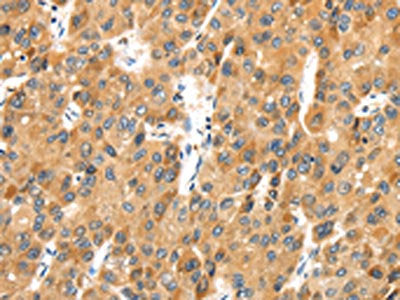 The image on the left is immunohistochemistry of paraffin-embedded Human liver cancer tissue using CSB-PA279229(MACC1 Antibody) at dilution 1/25, on the right is treated with synthetic peptide. (Original magnification: ×200)