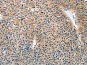 The image on the left is immunohistochemistry of paraffin-embedded Human liver cancer tissue using CSB-PA279247(IL22RA1 Antibody) at dilution 1/15, on the right is treated with fusion protein. (Original magnification: ×200)