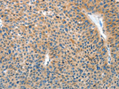 The image on the left is immunohistochemistry of paraffin-embedded Human liver cancer tissue using CSB-PA279247(IL22RA1 Antibody) at dilution 1/15, on the right is treated with fusion protein. (Original magnification: ×200)