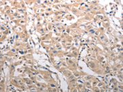 The image on the left is immunohistochemistry of paraffin-embedded Human lung cancer tissue using CSB-PA279438(RAD52 Antibody) at dilution 1/25, on the right is treated with synthetic peptide. (Original magnification: ×200)