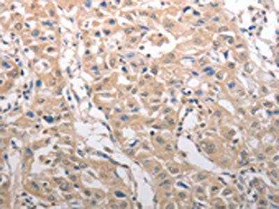 The image on the left is immunohistochemistry of paraffin-embedded Human lung cancer tissue using CSB-PA279438(RAD52 Antibody) at dilution 1/25, on the right is treated with synthetic peptide. (Original magnification: ×200)
