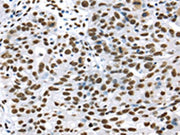 The image on the left is immunohistochemistry of paraffin-embedded Human breast cancer tissue using CSB-PA279529(DDX39B Antibody) at dilution 1/35, on the right is treated with synthetic peptide. (Original magnification: ×200)